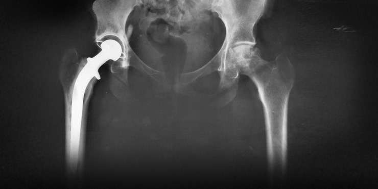 Тазобедренный сустав после эндопротезирования на рентгеновском снимке